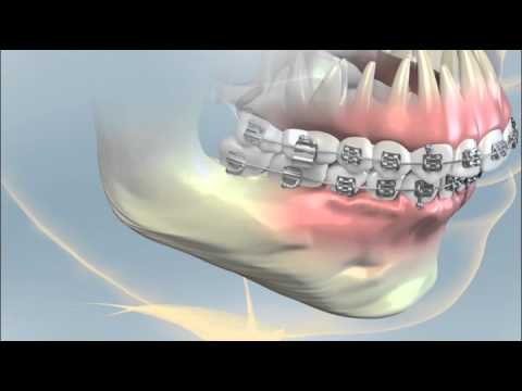 Orthognathic Surgery - AAOMS Video