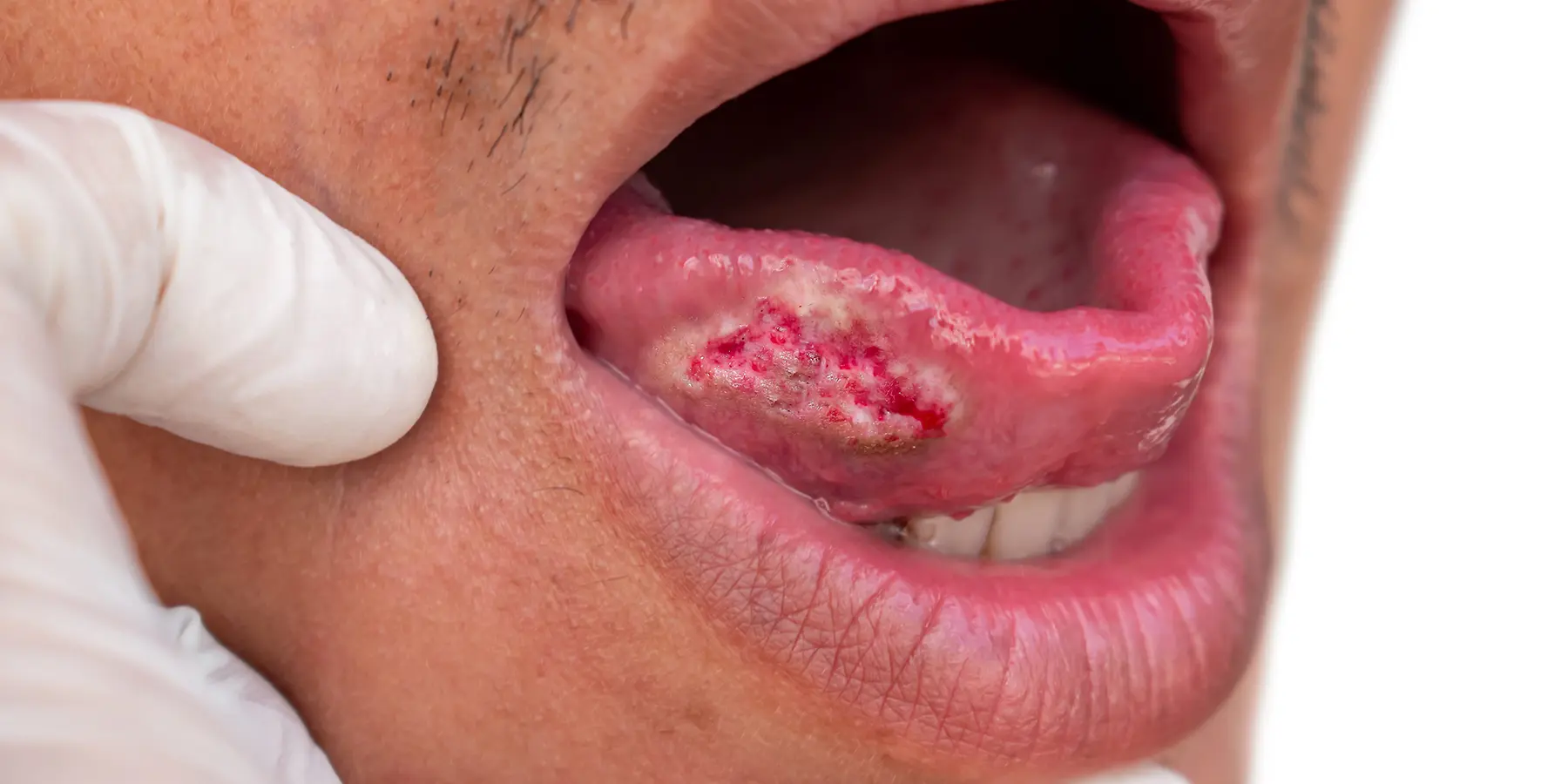 Oral Cancer: Know the Risk Factors, Save Your Life