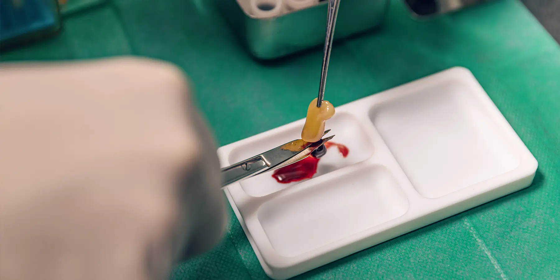 PRF: Improving Bone Grafting Outcomes and Soft Tissue Regeneration