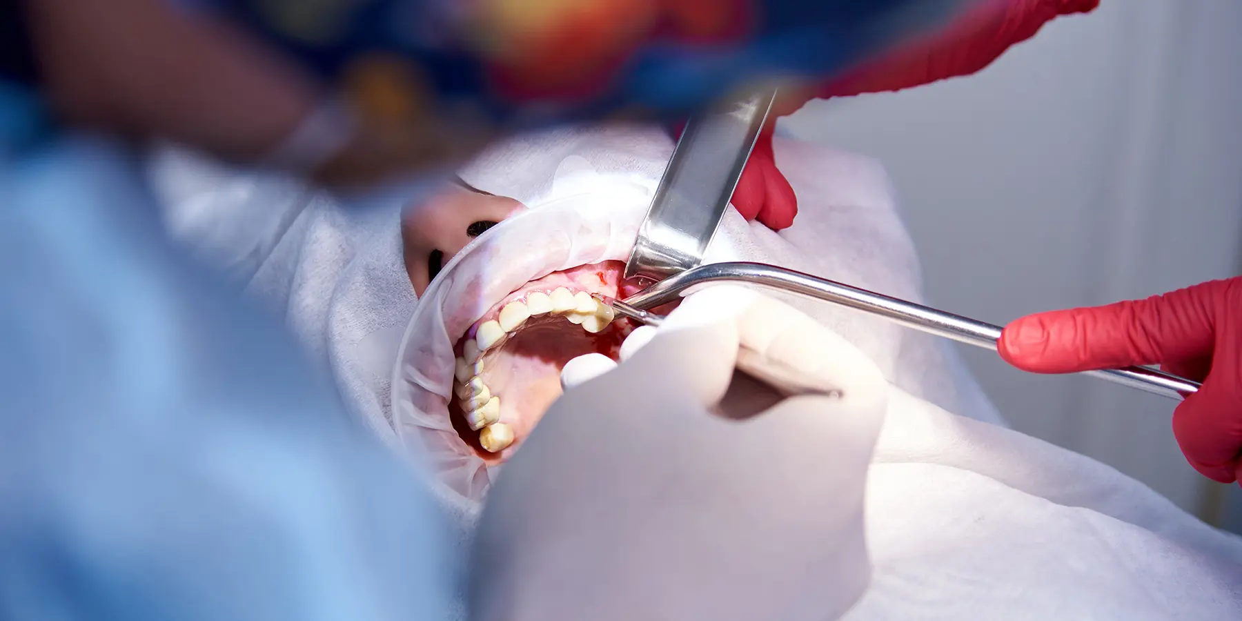 Preparing for Dental Implants: Why a Sinus Lift Might Be Required