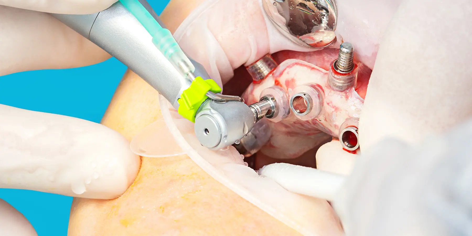 How Guided Implant Surgery Improves Accuracy and Outcomes