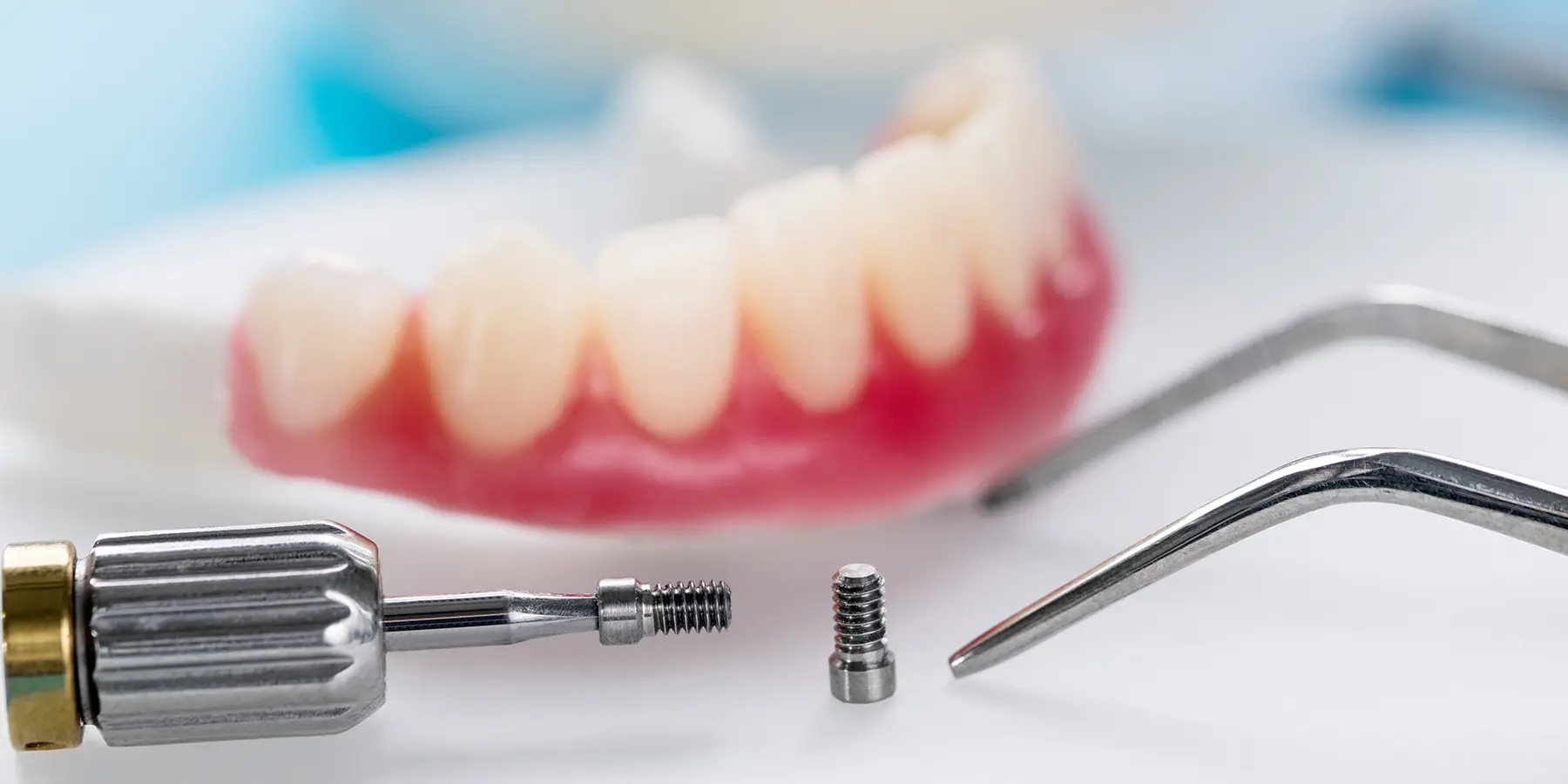 Implant Supported Dentures: A Stronger Alternative to Traditional Dentures