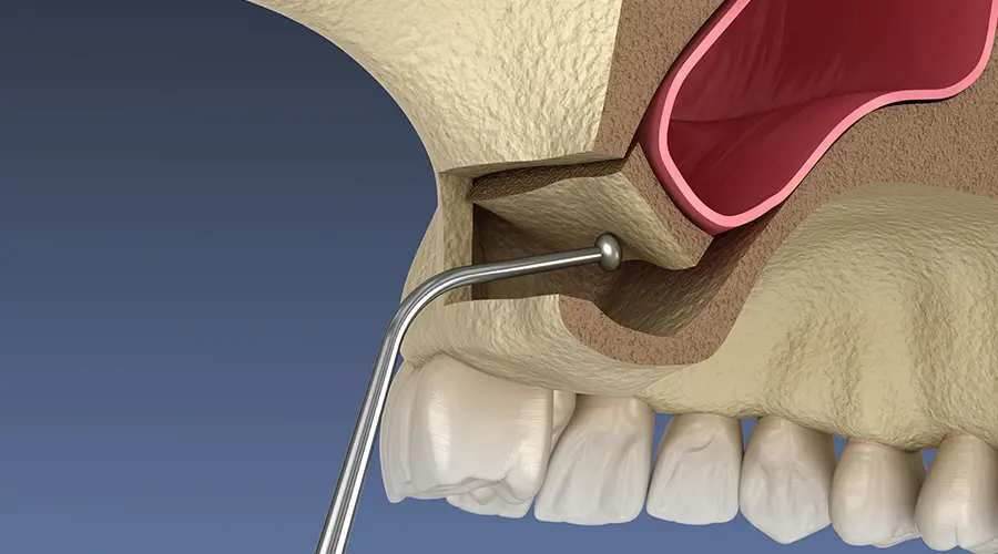 Sinus Lift