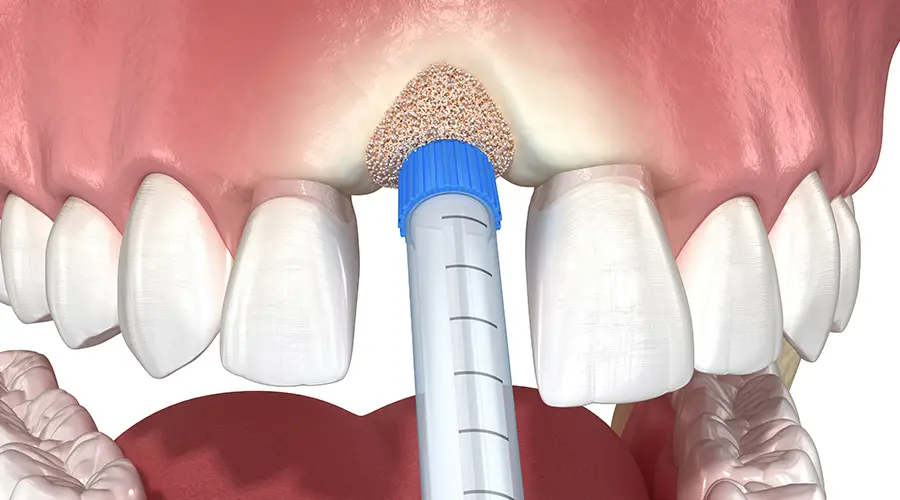 Socket Preservation
