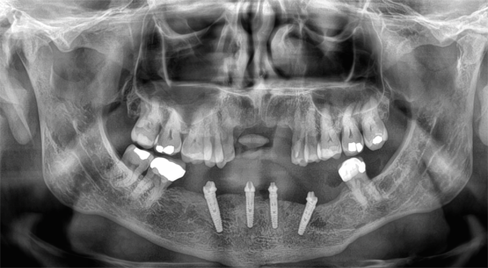 X-ray After All-on-4 Surgery