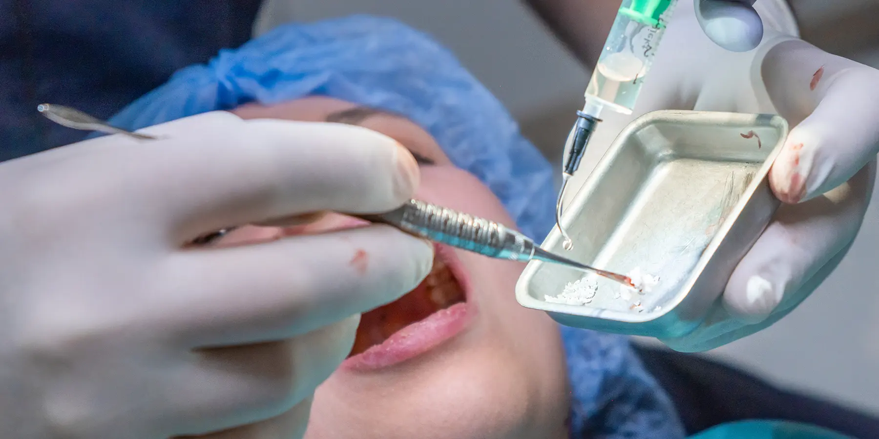 Bone Grafts and Dental Implants: How They Work Together