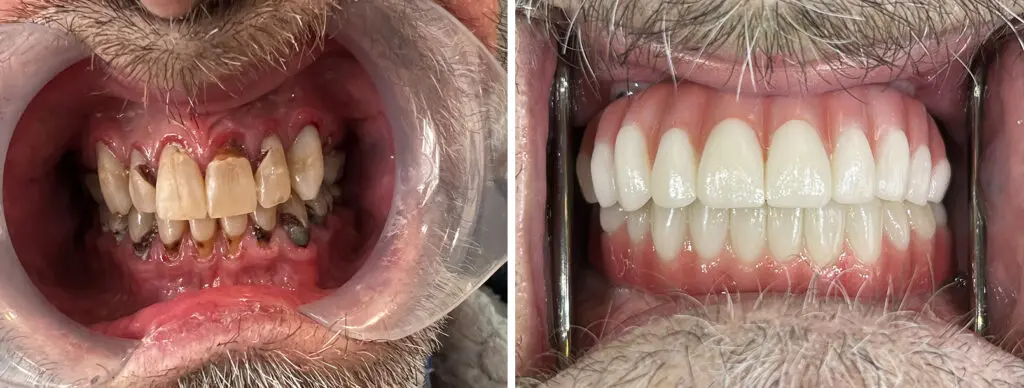 Left: Patient with severe tooth decay and failing teeth before full-arch dental implant treatment. Right: Upper and lower full-arch dental implant restorations with a healthy, natural-looking smile.