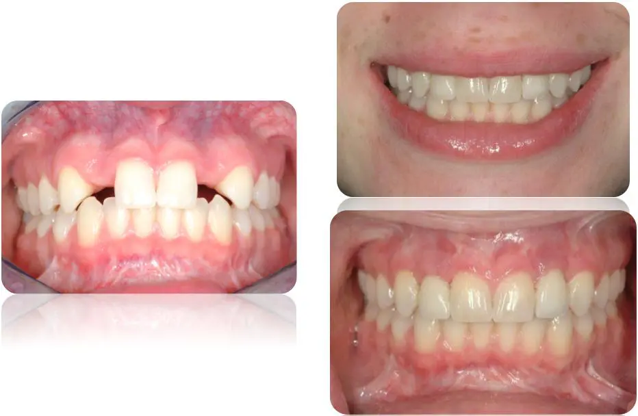 Before and after dental implant treatment replacing two missing upper canine teeth with natural-looking implant restorations.