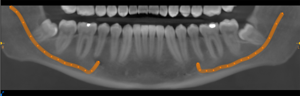 Coronectomy for Wisdom Teeth Near a Nerve