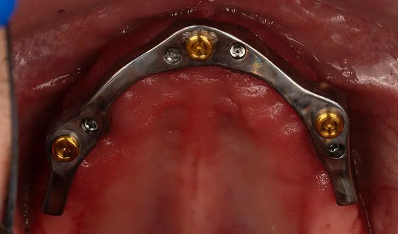 Upper arch implant-supported titanium bar attached to dental implants