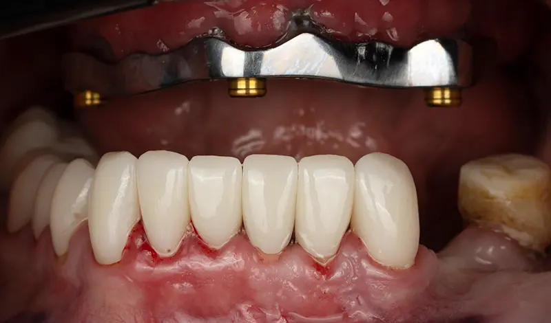 Front view of a titanium bar supporting an implant denture