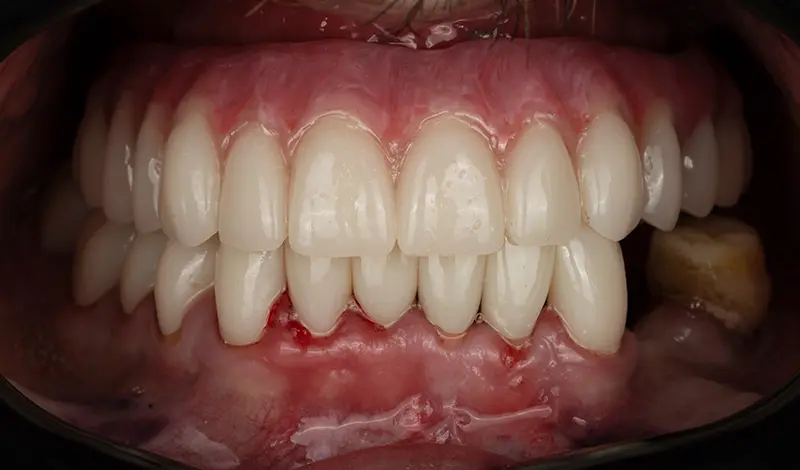 Bar attachment denture secured to an implant-supported titanium bar