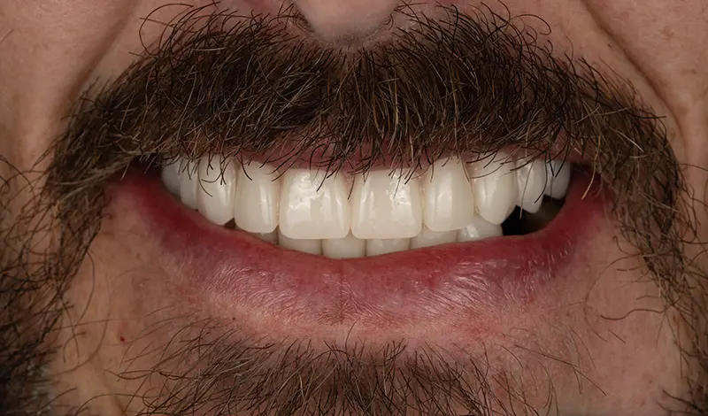 Patient smiling after treatment with upper bar attachment dentures