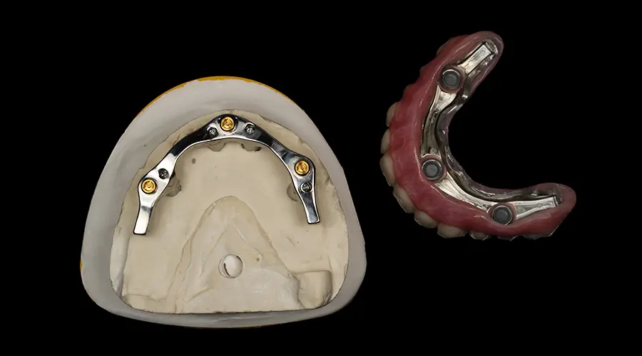 Titanium bar and removable implant-supported denture for bar attachment dentures