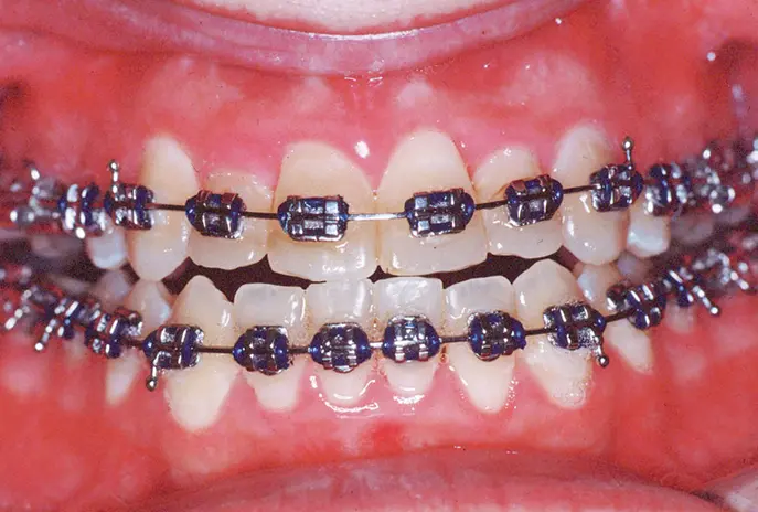After palatal expansion front view
