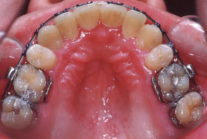 After palatal expansion palate view