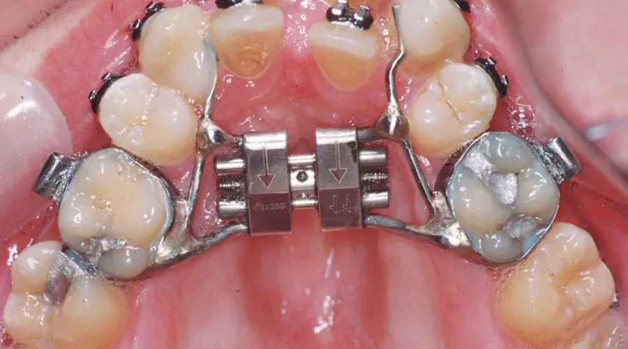 Oral Appliance