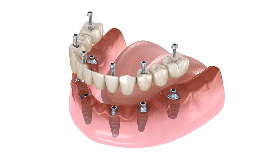 All-On-4 Dental Implants