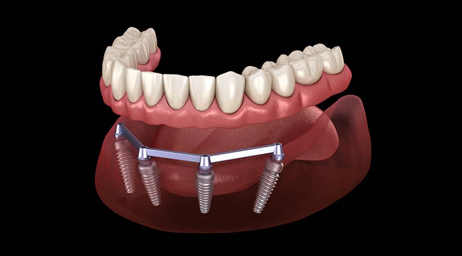 Bar Denture Attachment