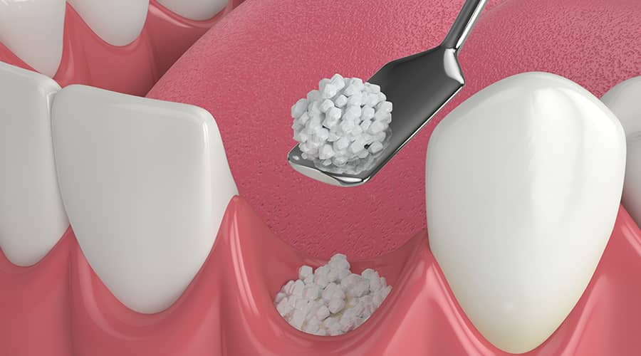 Dental Bone Grafting Dental Bone Grafting