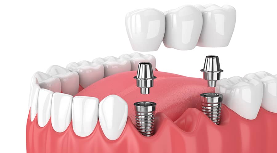 Dental Implants