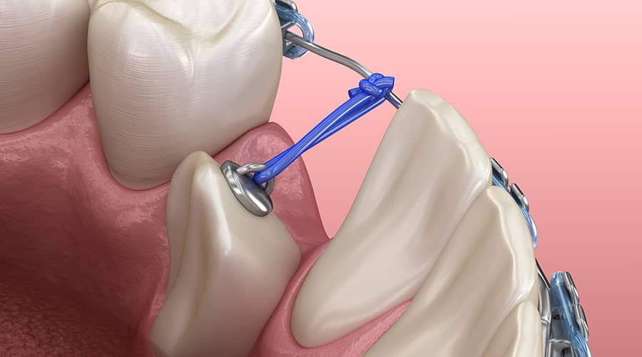 Impacted Canine Exposure & Tooth Bracketing