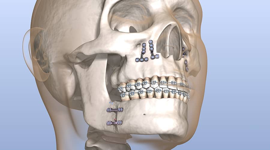 broken jaw wide mouth