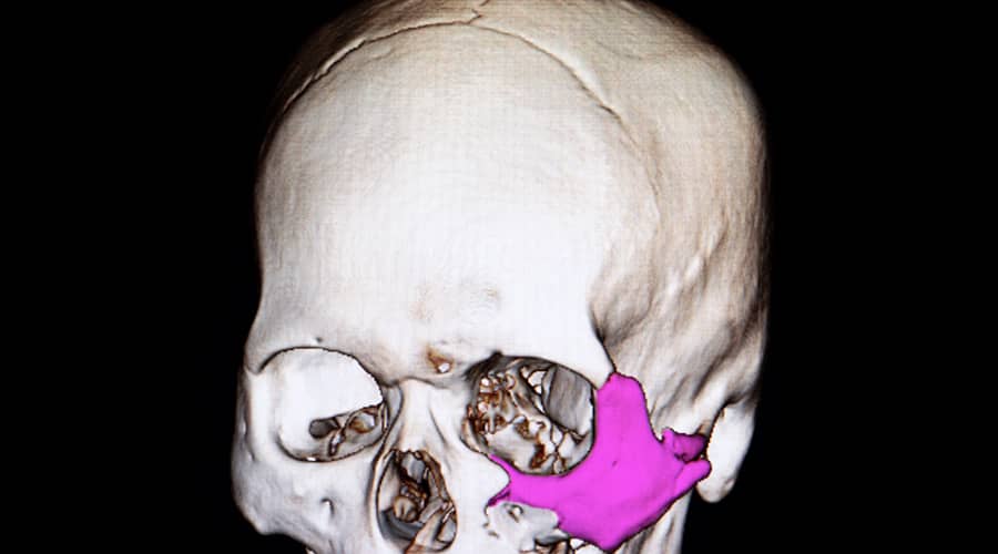 Eye Socket Fracture (Orbit Fracture)