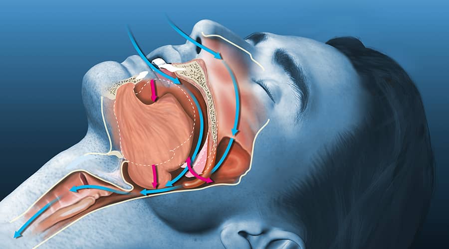 Sleep Apnea