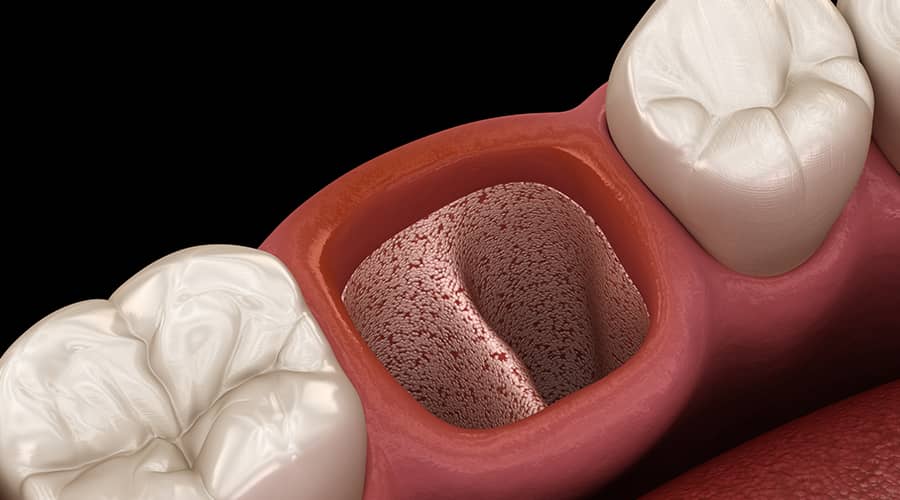 Dental Extraction Dental Extraction