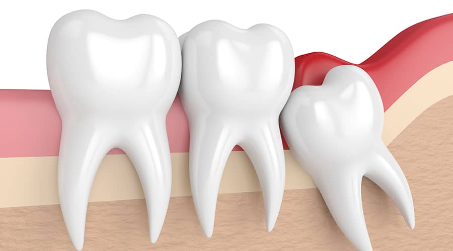 Wisdom Tooth / 3rd Molar