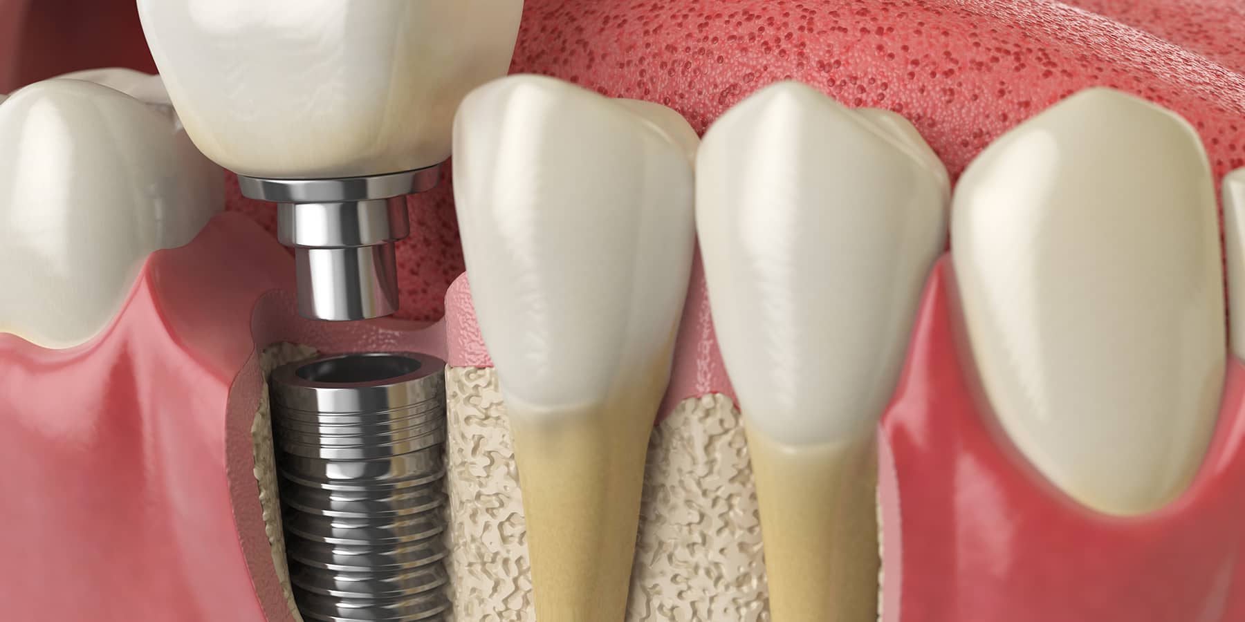 Dental Implant Procedure: What To Expect