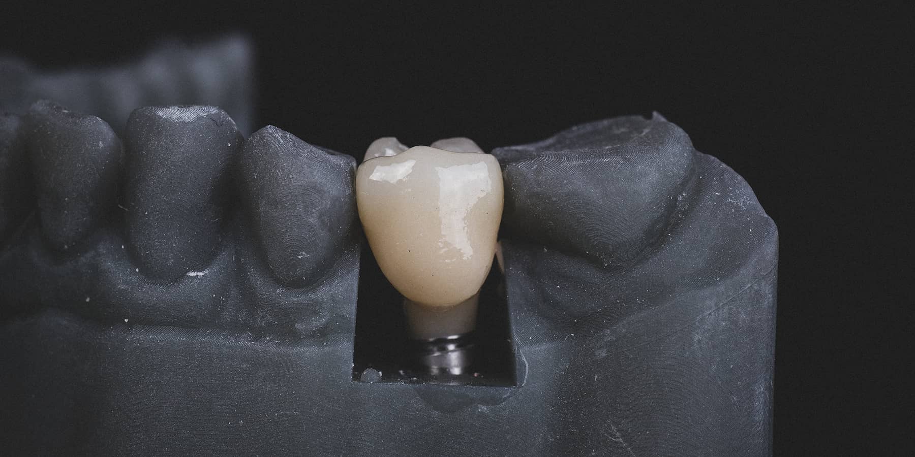 Am I Too Old for Dental Implants?