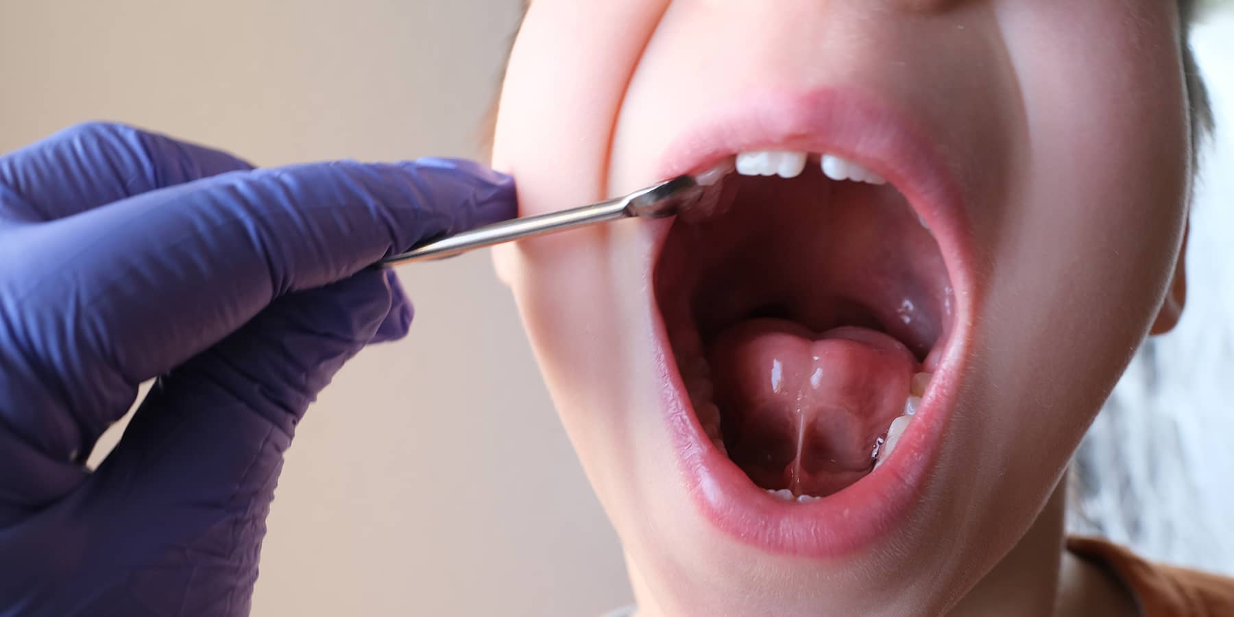 Lip-Tie and Tongue-Tie in Adults: Understanding the Symptoms and Treatments