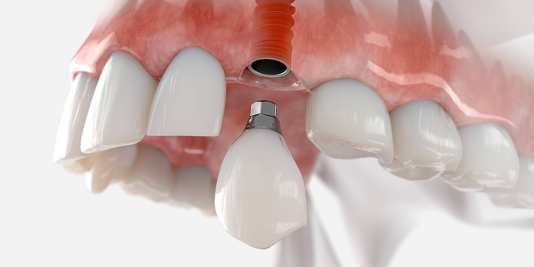 Dental Implant Procedure Step-by-Step: A Comprehensive Guide