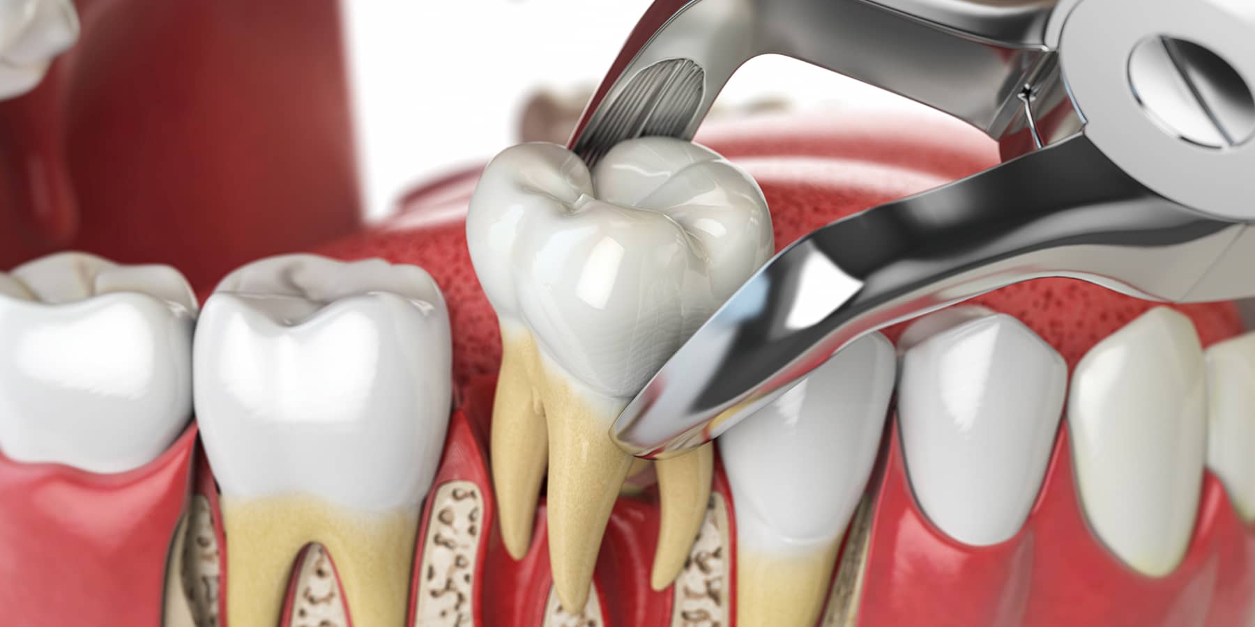 Understanding the Tooth Extraction and Implant Timeline