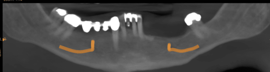 X-ray Before All-on-4 Surgery
